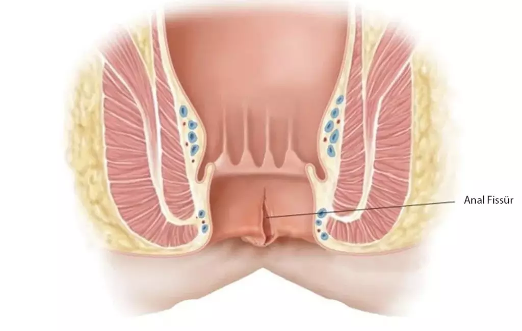 Anal fissür, ağrı, kanama