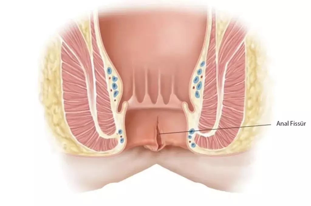 Anal fissür, ağrı, kanama ve rahatsızlık hissi gibi semptomlarla kendini
