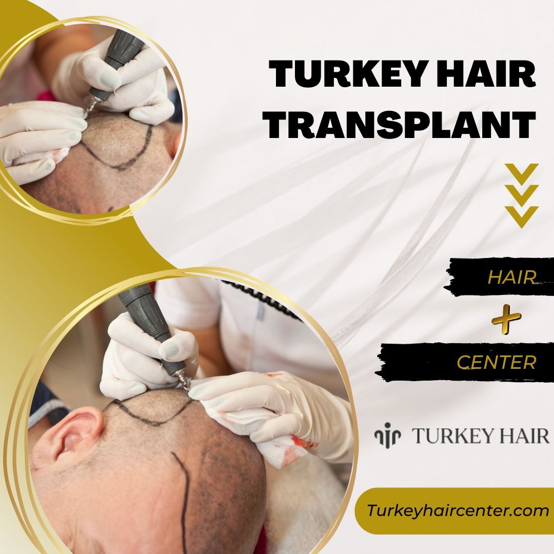 Türkiye Saç Ekimi Fiyatları (Turkey Hair Transplant Cost)